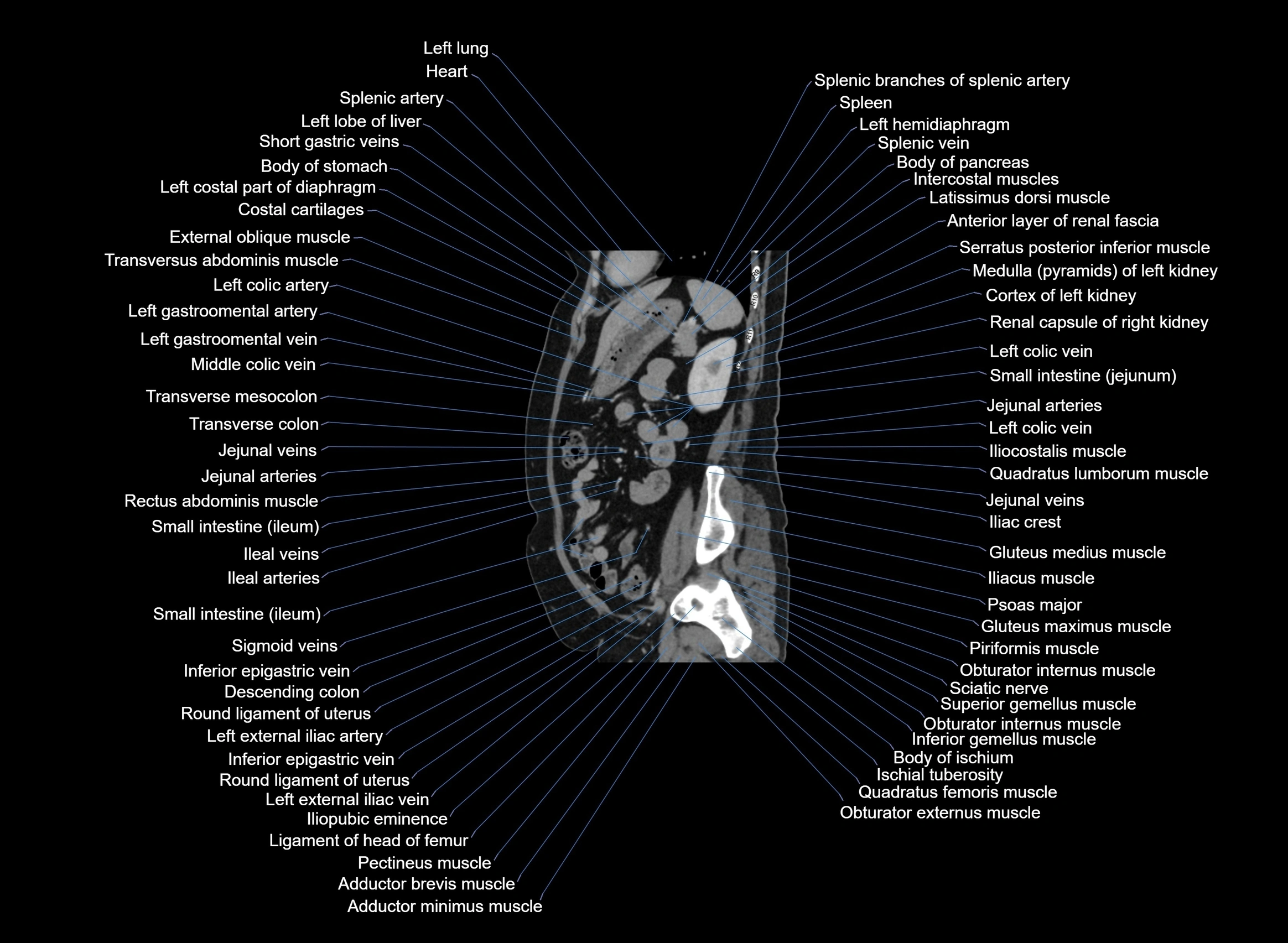 CT Abdomen sagittal cross sectional anatomy labelled radiology image -00036.webp